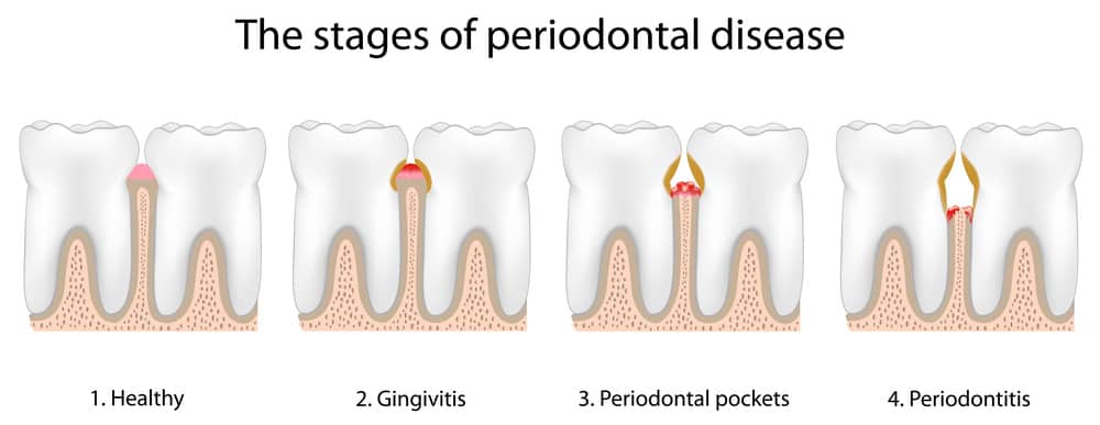 Periodontal Disease Toledo & Sylvania - Gum Disease Treatment